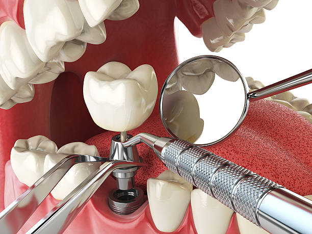 Best Emergency Dental Extractions in Falmouth, KY